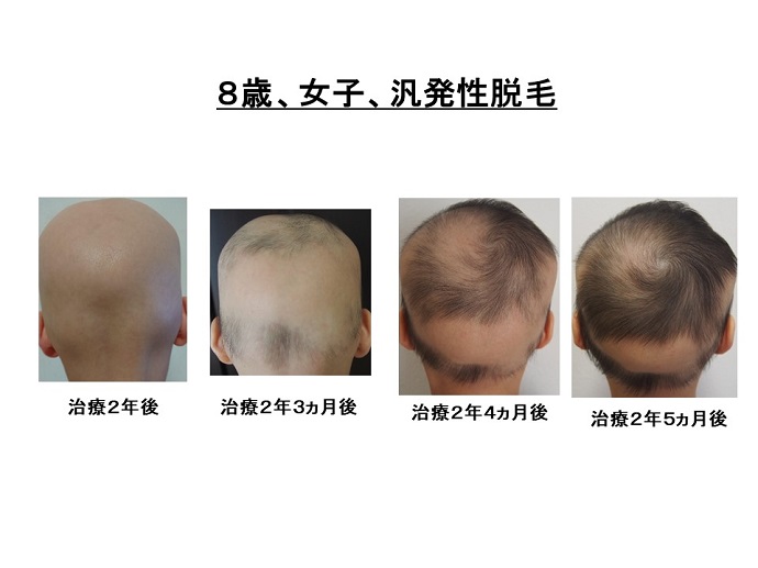 円形脱毛症　病院